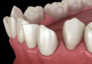 Illustration of gapped teeth