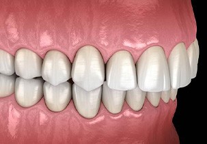 Illustration of an overbite