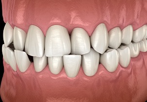 Illustration of a crossbite