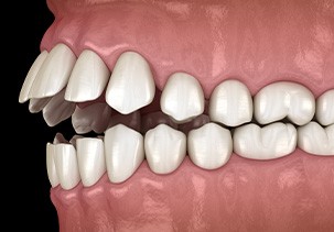 Illustration of an open bite