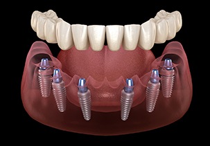 computer illustration depicting implant dentures