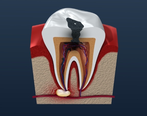 Animated tooth in need of root canal therapy