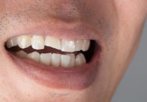 Smile with chipped front tooth