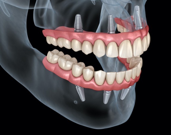 Animated smile with upper and lower dental implant supported dentures