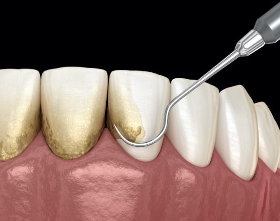 Animated smile during scaling and root planing treatment