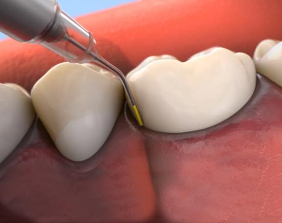 Animated smile during Arestin antibiotic therapy for gum disease