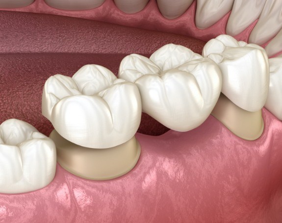 Animated smile during dental crown supported fixed bridge placement