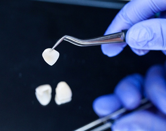 Dentist holding veneer in Jefferson with tweezers